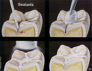 sigilarea suprafetelor dentare